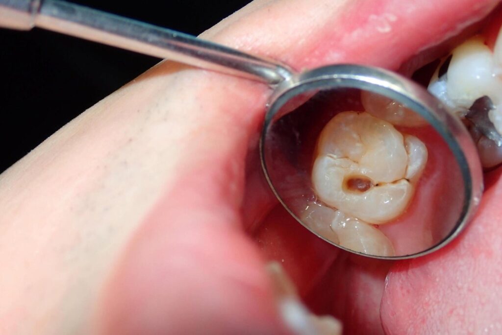 teeth filling (4)